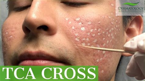 tca cross gone wrong|Worsening of Acne Scars from Trichloroacetic Acid CROSS.